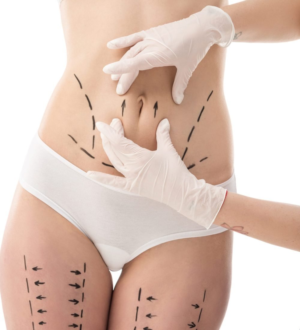 partial view of plastic surgeon in latex gloves and patient in underwear with marks on body isolated